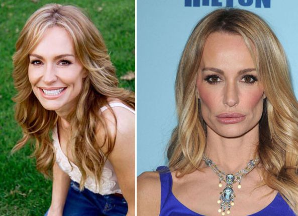  Taylor Armstrong before and after plastic surgery