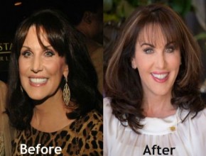 Robin McGraw before and after plastic surgery