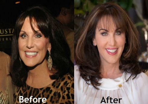 Robin McGraw before and after plastic surgery