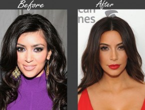 Kim Kardashian before and after plastic surgery