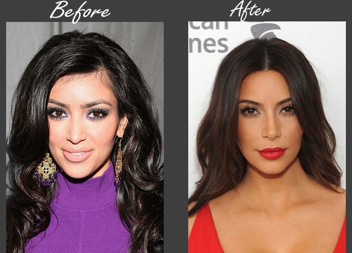 Kim Kardashian before and after plastic surgery