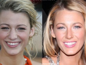 Blake Lively nose job before and after