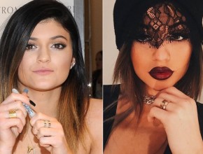 Kylie Jenner before and after lip filler