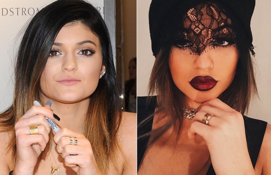 Kylie Jenner before and after lip filler