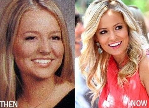 Emily Maynard nose job