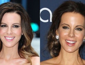 Kate Beckinsale before and after plastic surgery