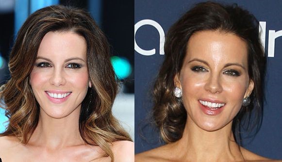 Kate Beckinsale before and after plastic surgery