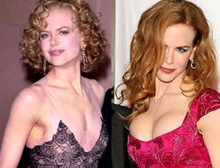 Nicole Kidman before and after breast augmentation