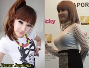 Park Bom before and after breasts augmentation