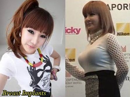 Park Bom before and after breasts augmentation