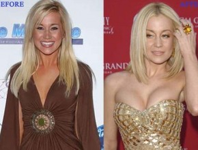 Kellie Pickler before and after plastic surgery