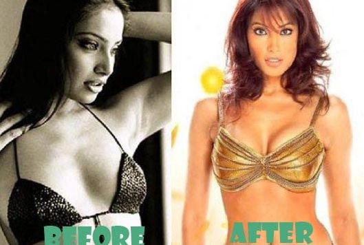Bipasha Basu before and after plastic surgery