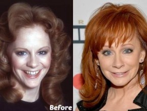 Reba McEntire before and after plastic surgery