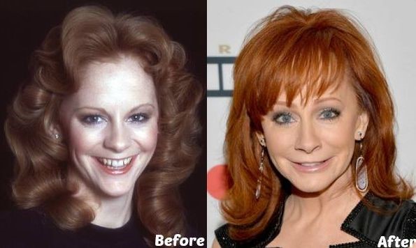 Reba McEntire before and after plastic surgery