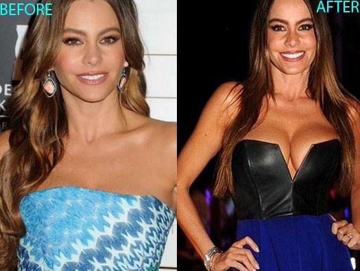 Sofia Vergara before and after breast augmentation