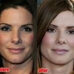 Sandra Bullock before and after plastic surgery