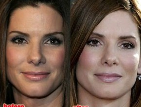Sandra Bullock before and after plastic surgery