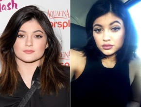 Kylie Jenner before and after Botox injection procedure
