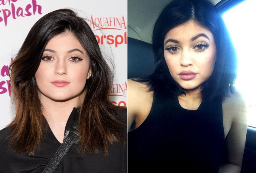 Kylie Jenner before and after Botox injection procedure