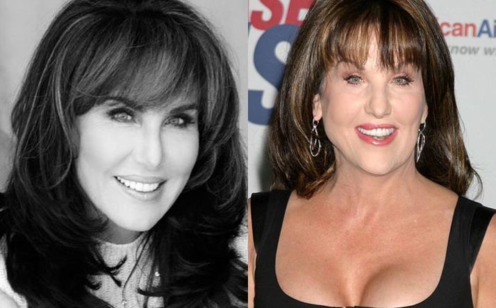 Robin McGraw before and after plastic surgery