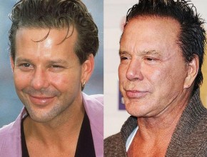 Mickey Rourke cosmetic procedures