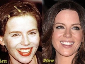 Kate Beckinsale before and after cosmetic procedure