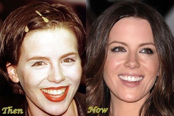 Kate Beckinsale before and after cosmetic procedure