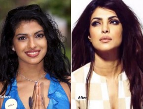 Priyanka Chopra before and after cosmetic surgery