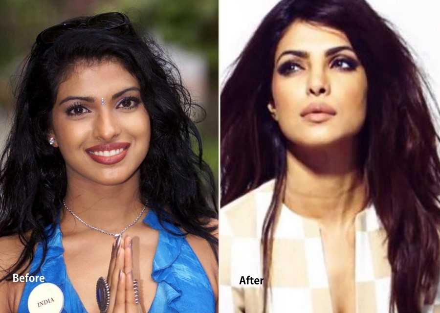 Priyanka Chopra before and after cosmetic surgery