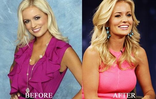 Emily Maynard breast augmentation