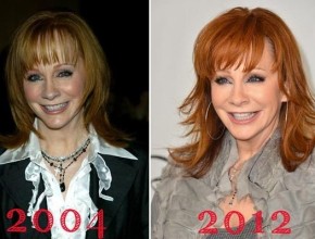 Reba McEntire before and after plastic surgery