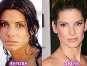 Sandra Bullock before and after plastic surgery