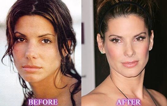 Sandra Bullock before and after plastic surgery