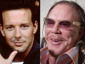 Mickey Rourke cosmetic procedures