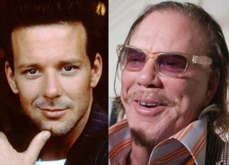 Mickey Rourke cosmetic procedures