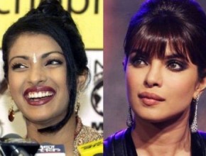 Priyanka Chopra before and after cosmetic surgery