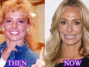 Taylor Armstrong before and after plastic surgery