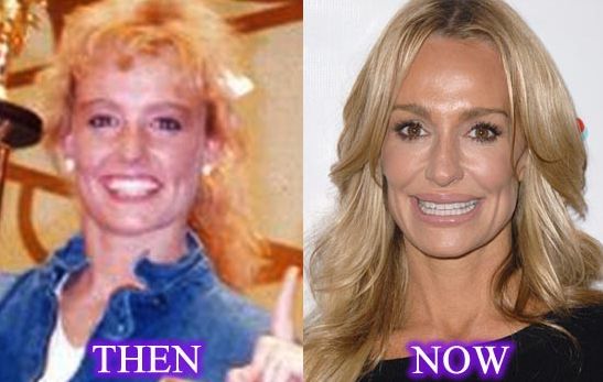  Taylor Armstrong before and after plastic surgery