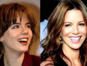 Kate Beckinsale before and after nose job