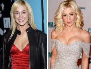 Kellie Pickler before and after breast augmentation and botox