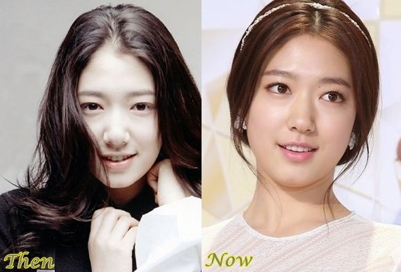 Park Shin Hye before and after plastic surgery