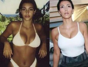 Kim Kardashian before and after breast augmentation