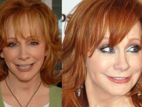 Reba McEntire before and after plastic surgery