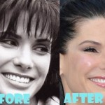 Sandra Bullock before and after plastic surgery