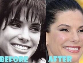 Sandra Bullock before and after plastic surgery