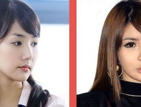 Park Bom before and after plastic surgery