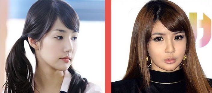 Park Bom before and after plastic surgery.