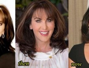 Robin McGraw plastic surgery