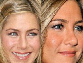 Jennifer Aniston before and after nose job