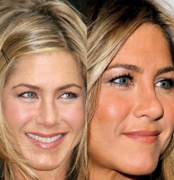 Jennifer Aniston before and after nose job